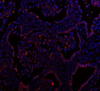 Immunofluorescent staining of FFPE human lung cancer tissue with GbetaL antibody (red) and DAPI nuclear stain (blue). HIER: steam section in pH8 EDTA buffer for 20 min.