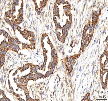 IHC staining of FFPE human pancreas ductal adenocarcinoma tissue with ITPA antibody. HIER: boil tissue sections in pH8 EDTA for 20 min and allow to cool before testing.
