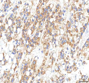 IHC staining of FFPE human liver cancer tissue with OMI antibody. HIER: boil tissue sections in pH8 EDTA for 20 min and allow to cool before testing.