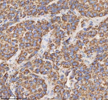 IHC staining of FFPE human liver cancer tissue with HADH antibody. HIER: boil tissue sections in pH8 EDTA for 20 min and allow to cool before testing.