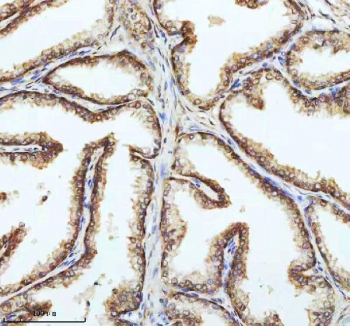 IHC staining of FFPE human prostate cancer tissue with PIN4 antibody. HIER: boil tissue sections in pH8 EDTA for 20 min and allow to cool before testing.