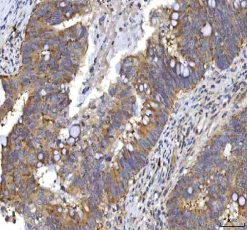 IHC staining of FFPE human rectum adenocarcinoma tissue with RASGRP3 antibody. HIER: boil tissue sections in pH8 EDTA for 20 min and allow to cool before testing.
