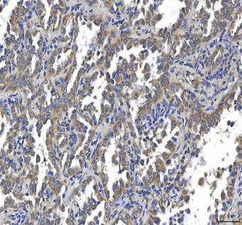 IHC staining of FFPE human lung cancer tissue with HTT antibody. HIER: boil tissue sections in pH8 EDTA for 20 min and allow to cool before testing.