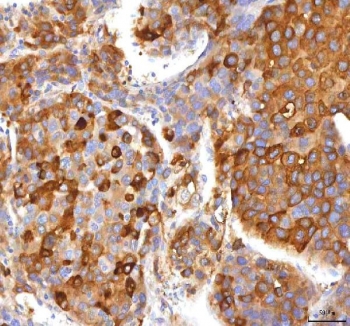 IHC staining of FFPE human liver cancer tissue with HSD17B13 antibody. HIER: boil tissue sections in pH8 EDTA for 20 min and allow to cool before testing.