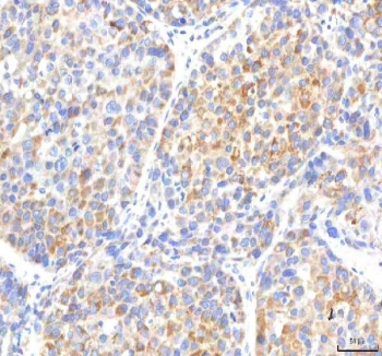 IHC staining of FFPE human liver cancer tissue with IPO8 antibody. HIER: boil tissue sections in pH8 EDTA for 20 min and allow to cool before testing.