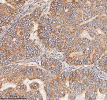 IHC staining of FFPE human ovarian tumor tissue with HDHD5 antibody. HIER: boil tissue sections in pH8 EDTA for 20 min and allow to cool before testing.