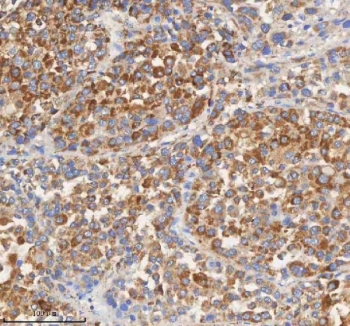 IHC staining of FFPE human liver cancer tissue with PCCA antibody. HIER: boil tissue sections in pH8 EDTA for 20 min and allow to cool before testing.