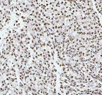 IHC staining of FFPE human testicular germ cell tumor tissue with RNA-binding motif protein 3 antibody. HIER: boil tissue sections in pH8 EDTA for 20 min and allow to cool before testing.