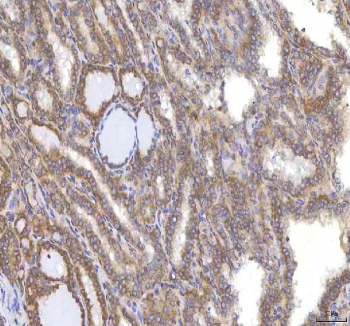 IHC staining of FFPE human thyroid cancer tissue with Oncomodulin 1 antibody. HIER: boil tissue sections in pH8 EDTA for 20 min and allow to cool before testing.