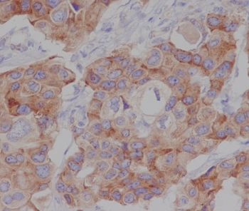 IHC staining of FFPE human breast cancer tissue with Phospho-mTOR antibody antibody. HIER: boil tissue sections in pH8 EDTA for 20 min and allow to cool before testing.