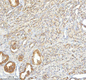 IHC staining of FFPE human prostate cancer tissue with SLC25A25 antibody. HIER: boil tissue sections in pH8 EDTA for 20 min and allow to cool before testing.
