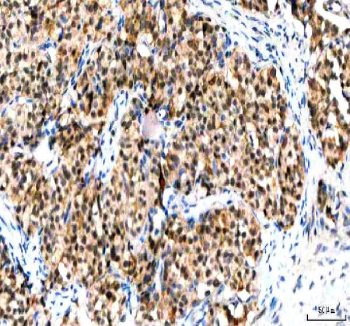 IHC staining of FFPE human lung cancer tissue with IPO9 antibody. HIER: boil tissue sections in pH8 EDTA for 20 min and allow to cool before testing.