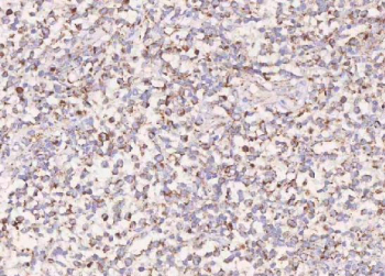 IHC staining of FFPE diffuse large B-cell lymphoma of human intestine tissue with IRS4 antibody. HIER: boil tissue sections in pH8 EDTA for 20 min and allow to cool before testing.