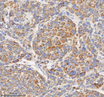 IHC staining of FFPE human liver cancer tissue with HADHB antibody. HIER: boil tissue sections in pH8 EDTA for 20 min and allow to cool before testing.