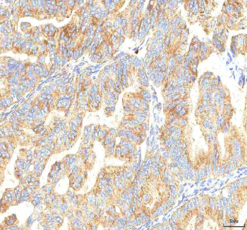 IHC staining of FFPE human ovarian cancer tissue with PCDHB14 antibody. HIER: boil tissue sections in pH8 EDTA for 20 min and allow to cool before testing.