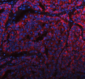 Immunofluorescent staining of FFPE human liver cancer tissue with MANSC4 antibody (red) and DAPI nuclear stain (blue). HIER: steam section in pH8 EDTA buffer for 20 min.