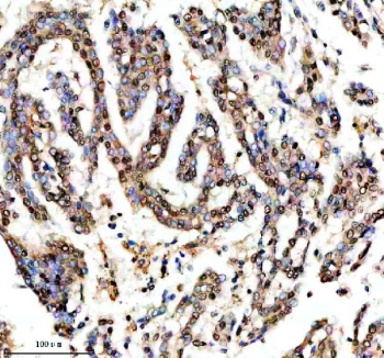 IHC staining of FFPE human lung cancer tissue with SHP2 antibody, HRP-secondary and DAB substrate. HIER: boil tissue sections in pH8 EDTA for 20 min and allow to cool before testing.