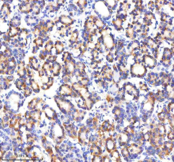 IHC staining of FFPE human thyroid cancer tissue with GABARAPL2 antibody, HRP-secondary and DAB substrate. HIER: boil tissue sections in pH8 EDTA for 20 min and allow to cool before testing.
