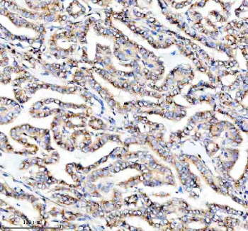 IHC staining of FFPE human thyroid cancer tissue with PRKCH antibody, HRP-secondary and DAB substrate. HIER: boil tissue sections in pH8 EDTA for 20 min and allow to cool before testing.
