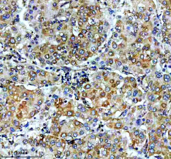 IHC staining of FFPE human liver cancer tissue with VASP antibody, HRP-secondary and DAB substrate. HIER: boil tissue sections in pH8 EDTA for 20 min and allow to cool before testing.
