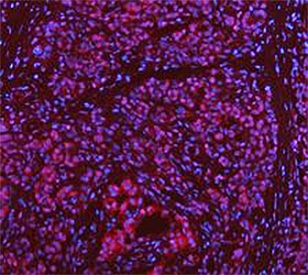 Immunofluorescent staining of FFPE human pancreas cancer tissue with DEAD box protein 1 antibody. HIER: boil tissue sections in pH8 EDTA for 20 min and allow to cool before testing.
