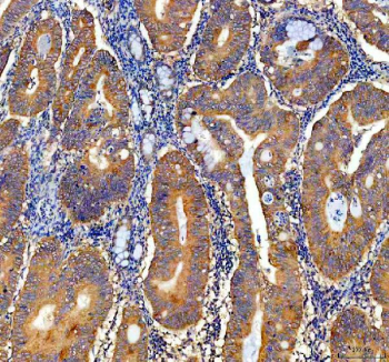 IHC staining of FFPE human colon cancer tissue with NQO1 antibody, HRP-secondary and DAB substrate. HIER: boil tissue sections in pH8 EDTA for 20 min and allow to cool before testing.