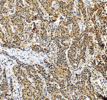 IHC staining of FFPE human liver cancer tissue with PSMA5 antibody, HRP-secondary and DAB substrate. HIER: boil tissue sections in pH8 EDTA for 20 min and allow to cool before testing.