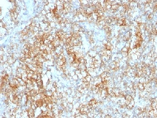 IHC testing of FFPE human renal cell carcinoma with CD147 antibody (clone 8D6).