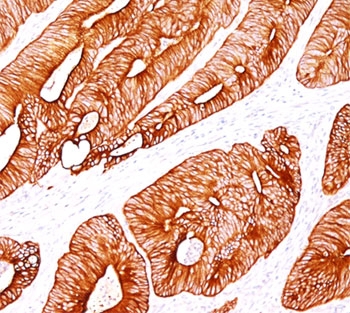 Cytokeratin 8 antibody K8/383 immunohistochemistry colon carcinoma