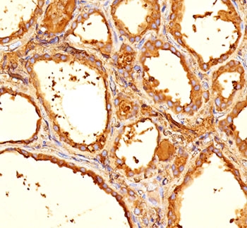 Thyroglobulin antibody 6E1 immunohistochemistry thyroid