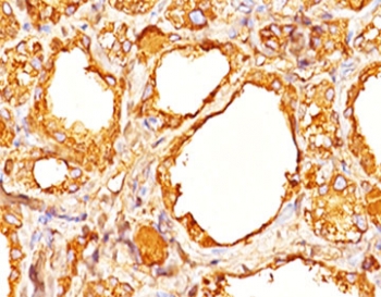 Thyroglobulin antibody 2H11 + 6E1 immunohistochemistry thyroid