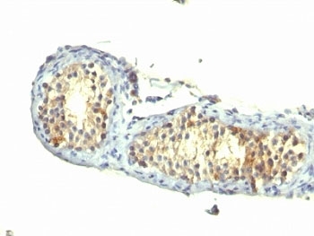 Formalin-fixed, paraffin-embedded human testicular carcinoma stained with TGF-alpha antibody (1E8-G6)