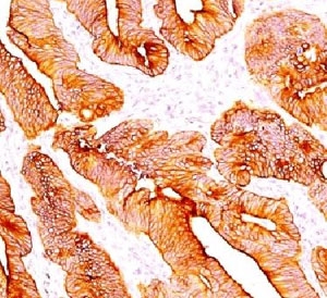 IHC testing of FFPE human colon carcinoma and Multi Cytokeratin antibody (clone C11).