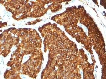IHC: Formalin-paraffin human pheochromocytoma stained with Chromogranin A antibody (CHGA/777)