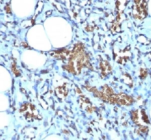 IHC-P: Formalin-fixed, paraffin-embedded human angiosarcoma stained with Glycophorin A antibody (clone GYPA/280).