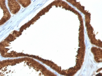IHC: Formalin-fixed, paraffin-embedded human colon carcinoma stained with IDH1 antibody (clone IDH1/1152).