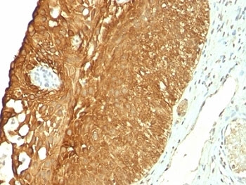 IHC: Formalin-fixed, paraffin-embedded human cervical carcinoma stained with CK19 antibody (clone KRT19/800).