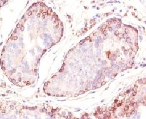 IHC: Formalin-fixed, paraffin-embedded human testicular carcinoma stained with MAGE-1 antibody (clone MZ2E/838).