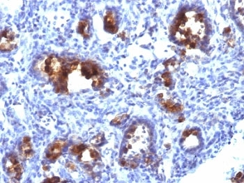IHC: Formalin-fixed, paraffin-embedded human gastric carcinoma stained with MUC3 antibody (MUC3/1154).