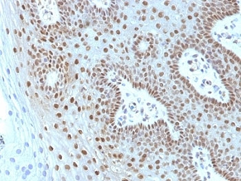 IHC: Formalin-fixed, paraffin-embedded human cervical carcinoma stained with c-Myc antibody (MYC275 + MYC909).