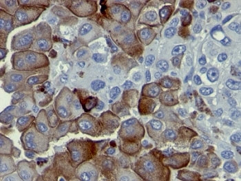 IHC analysis of formalin-fixed, paraffin-embedded human melanoma stained with p75NTR antibody (clone NGFR5).