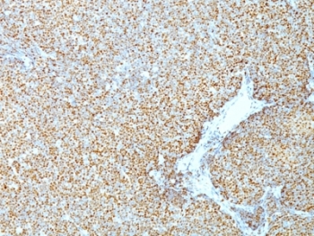 IHC: Formalin-fixed, paraffin-embedded human mantle cell lymphoma stained with Cyclin D1 antibody (CCND1/809).
