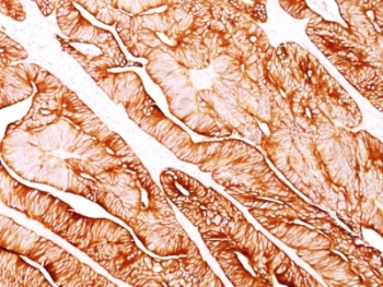IHC analysis of formalin-fixed, paraffin-embedded human colon carcinoma stained with Cytokeratin 5/8 antibody (clone C-50). Required HIER: digest sections with Trypsin at 1mg/ml, 15 min, at RT.
