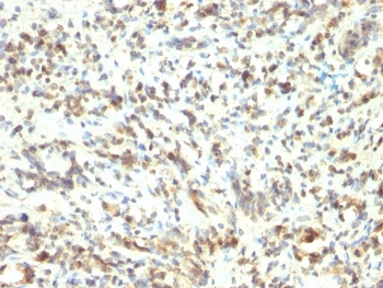 IHC staining of FFPE human Rhabdomyosarcoma with MyoD1 antibody (clone 5.8A). HIER: boil tissue sections in pH 9 10mM Tris with 1mM EDTA for 20 min and allow to cool before testing.