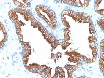 IHC analysis of FFPE human prostate carcinoma with Cytokeratin 8/18 antibody (clone KRT8.18/1346). Required HIER: boil tissue sections in pH 9 10mM Tris with 1mM EDTA for 10-20 min.