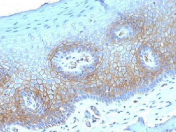 IHC testing of FFPE human cervical carcinoma with Thrombomodulin antibody (clone THBD/1782). HIER: boil tissue sections in 10mM Tris buffer with 1mM EDTA, pH 9, for 10-20 min followed by cooling at RT for 20 min.