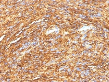 IHC testing of FFPE human gastrointestinal stromal tumor (GIST) with DOG 1 antibody (DG1/1484). Required HIER: boil tissue sections in pH 9 10mM Tris with 1mM EDTA for 10-20 min.