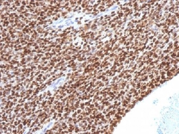 IHC testing of FFPE Ewings sarcoma with NKX2.2 antibody (clone NX2/1524). HIER: steam sections in 10mM citrate buffer, pH 6, for 10-20 min.