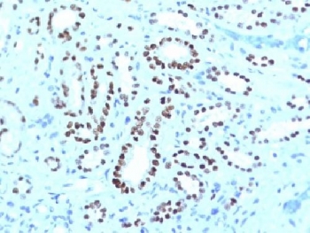 IHC testing of FFPE human renal cell carcinoma with PAX8 antibody cocktail (clone PAX8-1491 + PAX8/1492). Required HIER: boil tissue sections in 10mM Tris buffer with 1mM EDTA, pH 9, for 10-20 min followed by cooling at RT for 20 minutes.