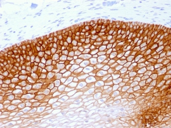 IHC testing of FFPE human cervical squamos cell carcinoma with recombinant CD44v4 antibody (clone rCD44v4/1219). Required HIER: steam sections in pH 9 10mM Tris with 1mM EDTA buffer for 10-20 min.